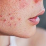 7 Cara Ampuh Menghilangkan Jerawat Secara Alami