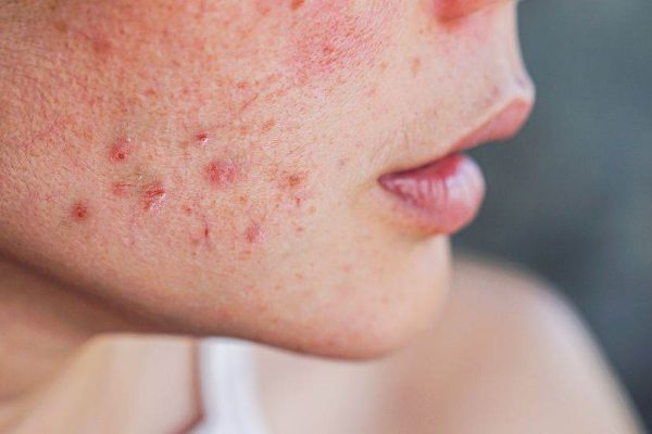 7 Cara Ampuh Menghilangkan Jerawat Secara Alami 7 Cara Ampuh Menghilangkan Jerawat Secara Alami