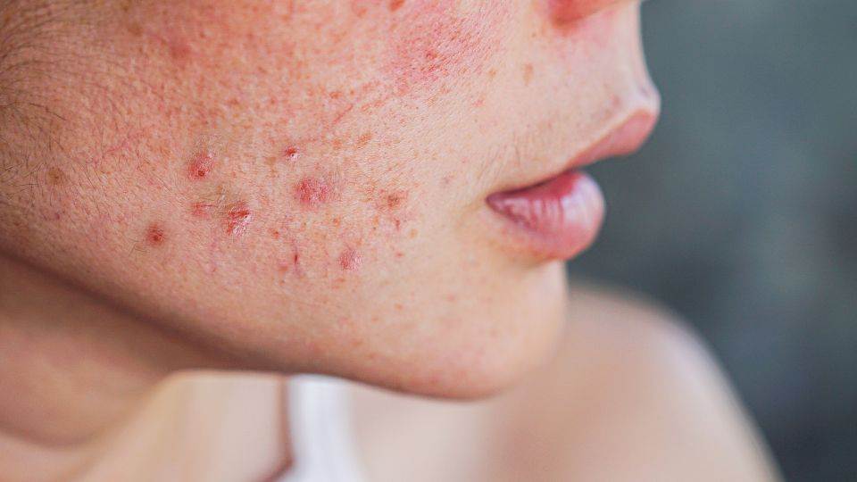 7 Cara Ampuh Menghilangkan Jerawat Secara Alami
