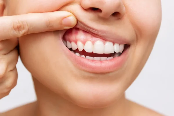 7 Cara Alami Menjaga Kesehatan Gusi 7 Cara Alami Menjaga Kesehatan Gusi