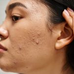7 Cara Ampuh Menghilangkan Jerawat Secara Alami