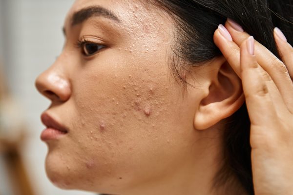 7 Cara Ampuh Menghilangkan Jerawat Secara Alami 7 Cara Ampuh Menghilangkan Jerawat Secara Alami