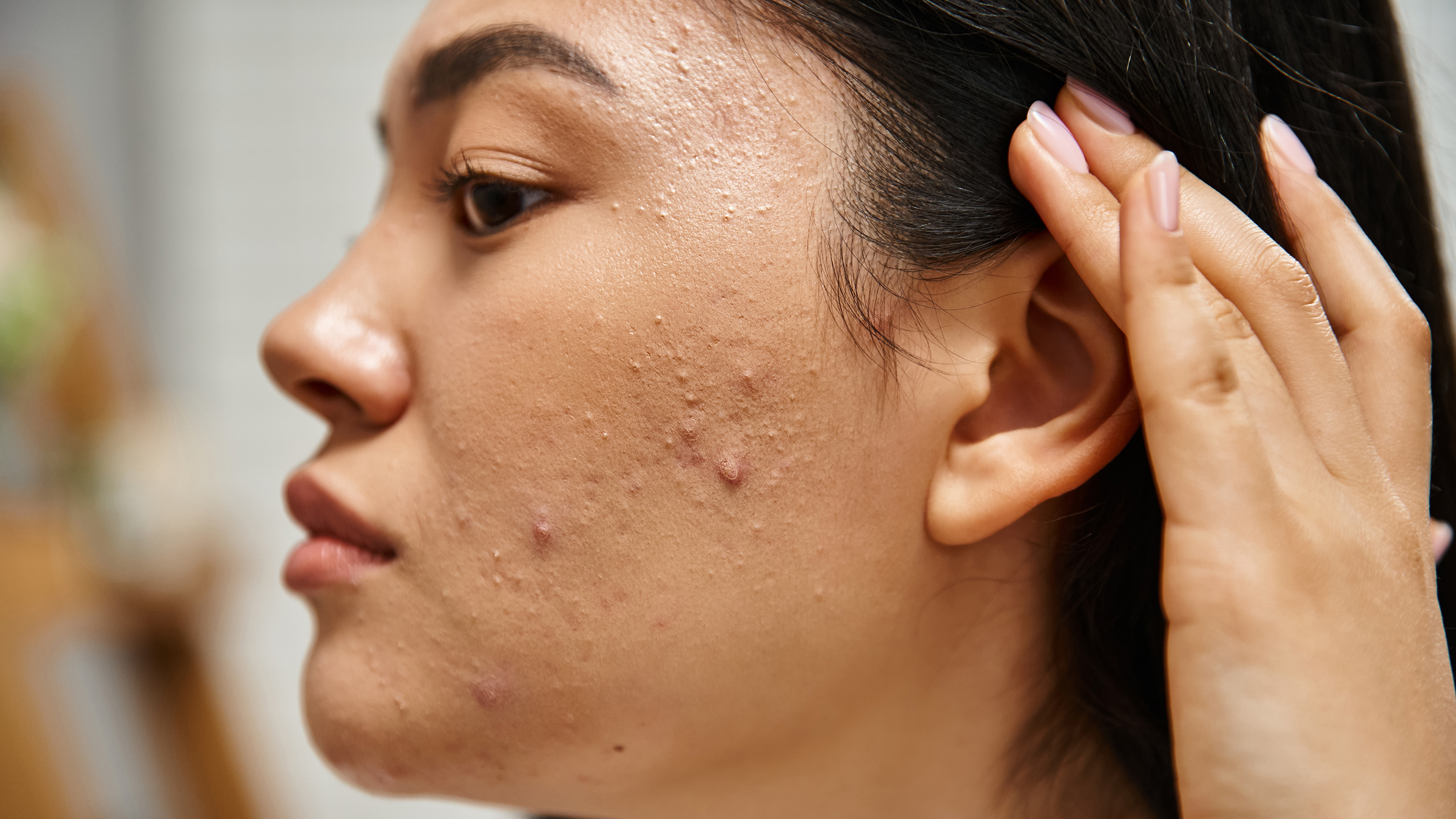 7 Cara Ampuh Menghilangkan Jerawat Secara Alami
