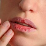 10 Cara Alami Mengatasi Bibir Kering dan Pecah-Pecah