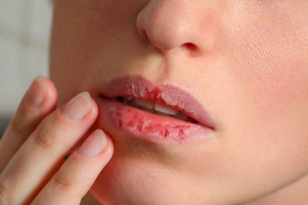 10 Cara Alami Mengatasi Bibir Kering dan Pecah-Pecah