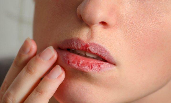 10 Cara Alami Mengatasi Bibir Kering dan Pecah-Pecah