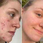10 Cara Mengatasi Jerawat di Dagu Secara Alami