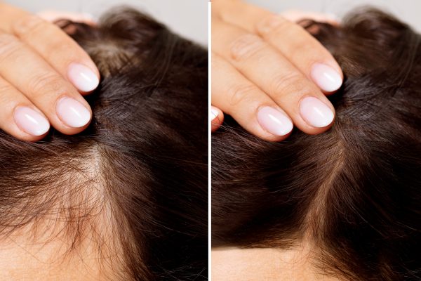 7 Tips Mengatasi Rambut Rontok Tanpa Obat Kimia